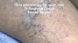 Micro sclerotherapy for spider veins