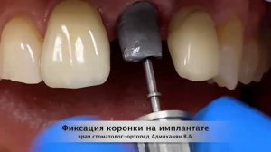 Фиксация коронки на импланте. Работа доктора хирурга-стоматолога Адилханян В.А.