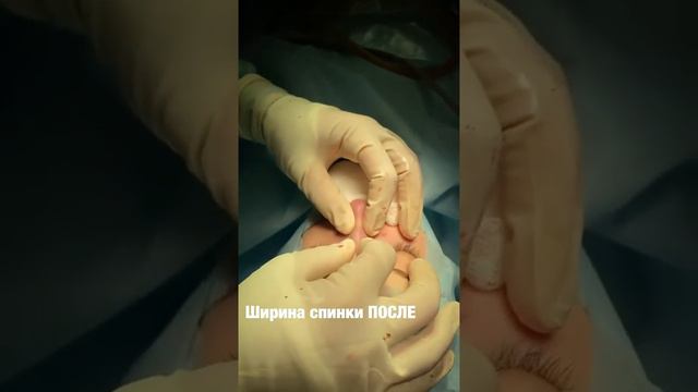 Ринопластика До/После.