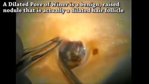 DPOW vs Pimple Popping