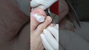 Вросший ноготь работа подолога с вросшим ногтем