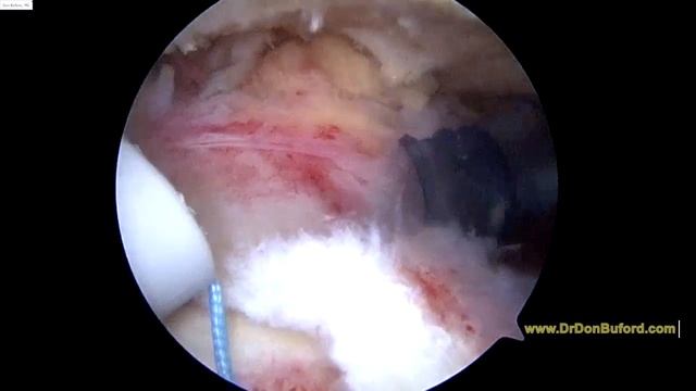 L Shoulder Rotator cuff repair and biceps tenodesis 2018 11 12 KD смотреть онлайн