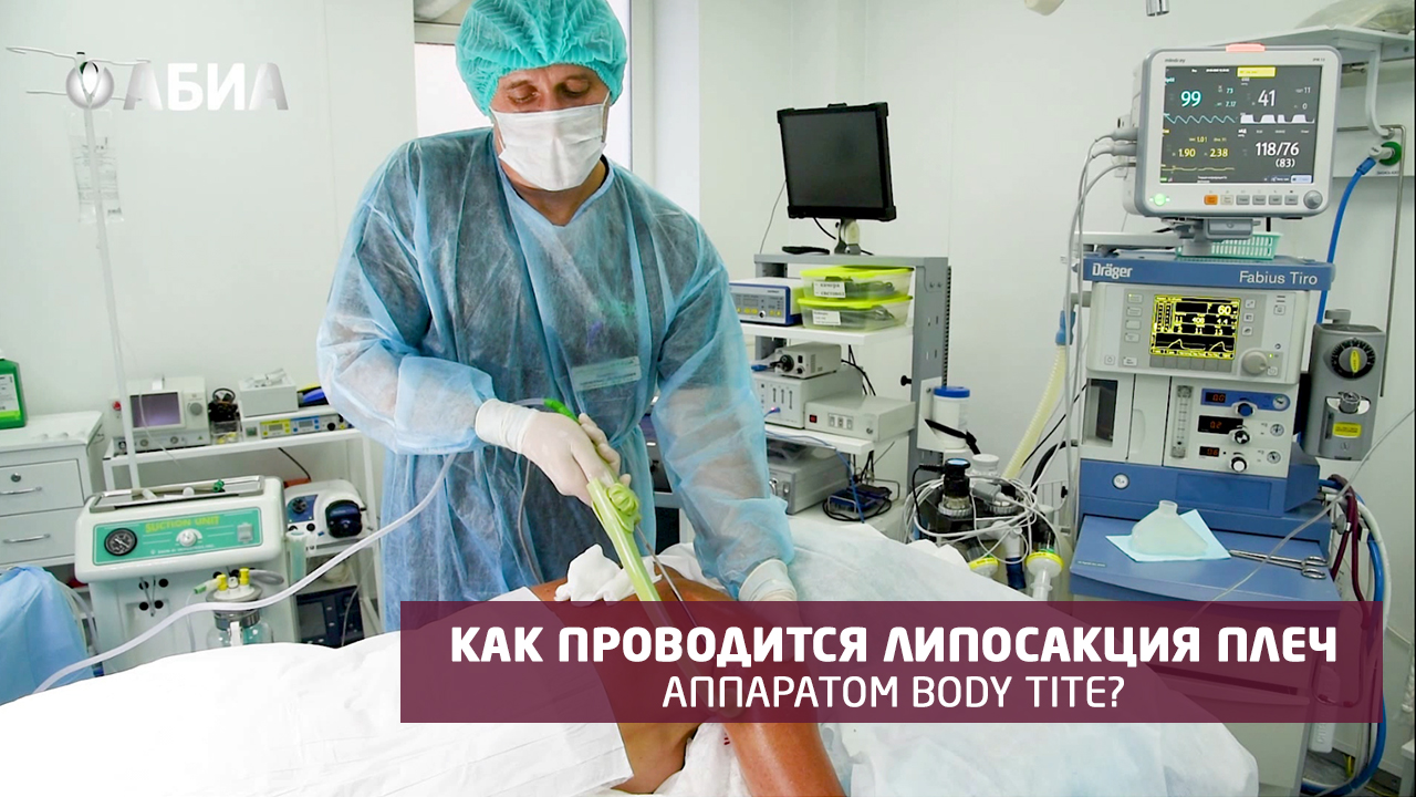 Как проводится радиочастотная липосакция плеч аппаратом Body Tite? ?