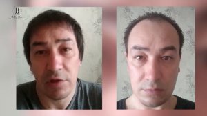Пересадка волос, видео отзыв с результатом через 6 месяцев