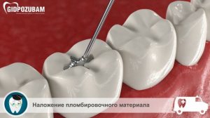 Этапы лечения кариеса