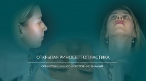 Открытая риносептопластика до, через 2 недели и через один месяц после