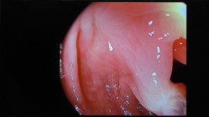 14 Федоров ЕД Специализированные петли для эндоскопической полипэктомии