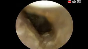 Острый наружный #грибковый #отит #отомикоз, диагностика лечение в КЛИНИКА ОБРАЗЦОВА