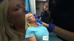 Radiesse Filler for Face Volumization and Lift