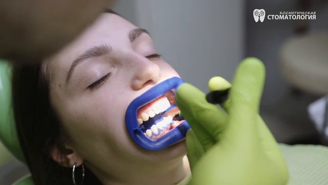 Отбеливание Philips ZOOM White Speed / ZOOM 4 - Д-р Ирина Барциковская. Косметическая Стоматология смотреть онлайн