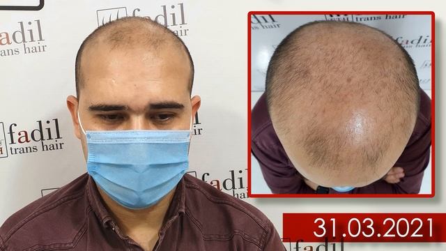 VII - степень алопеция | Иккинчи этап