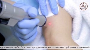 Удаление новообразований в клинике BL на эрбиевом лазере