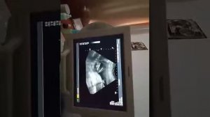 Узи малыша на 17й неделе