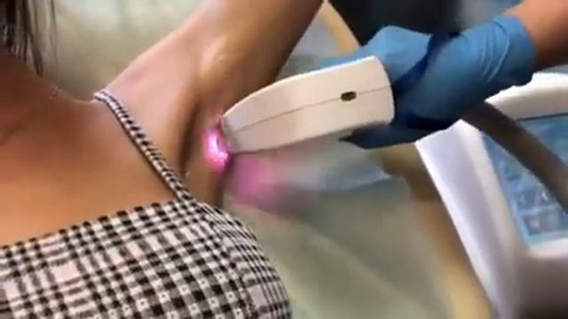 Лазерная эпиляция || Milner Medical смотреть онлайн