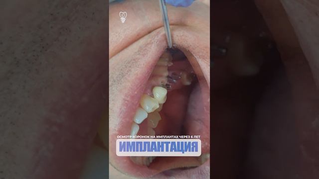 Осмотр коронок на имплантах через 6 лет.  Examination of crowns on implants after 6 years.