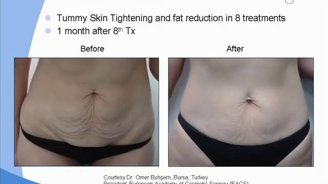 Радиолифтинг в Бьюти Парке смотреть онлайн