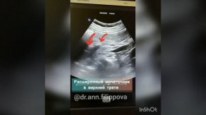 КАМЕНЬ В МОЧЕТОЧНИКЕ 😰 Ультразвуковая диагностика 🏥 UROLITHIASIS on ultrasound