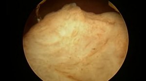 ТУР мочевого пузыря с опухолью