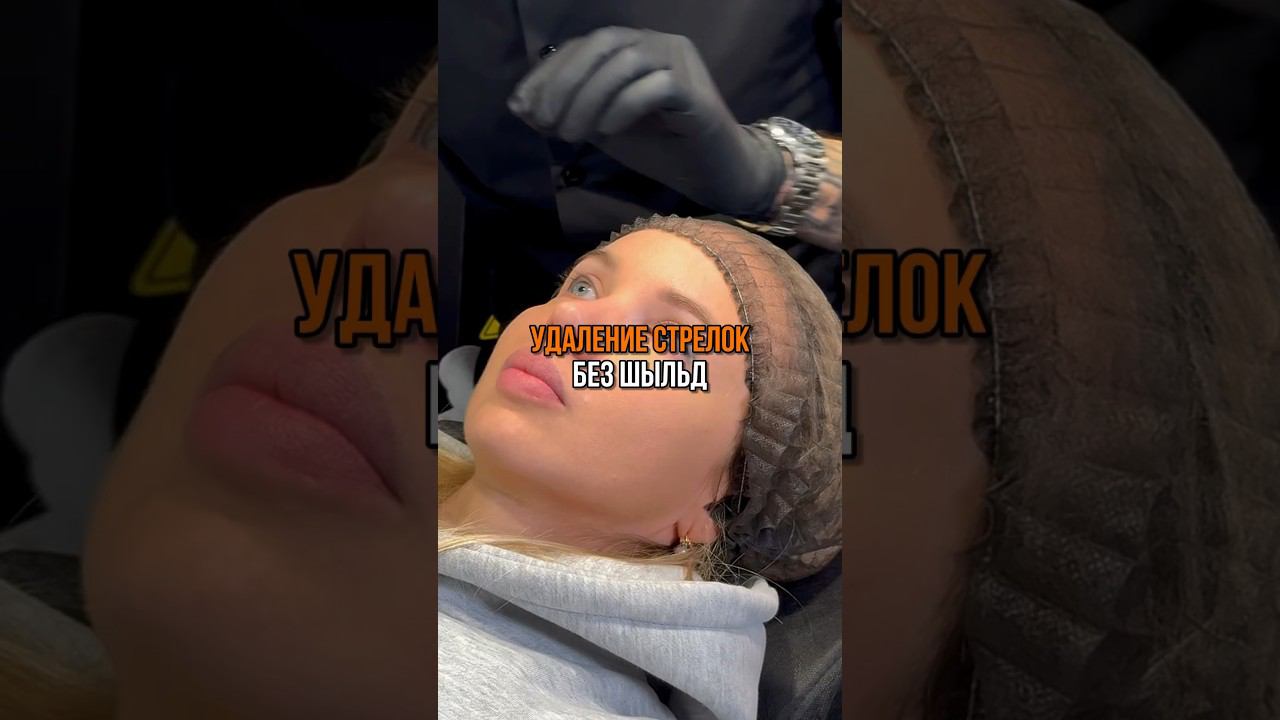 УДАЛЕНИЕ ТАТУАЖА СТЕЛОК С ГЛАЗ