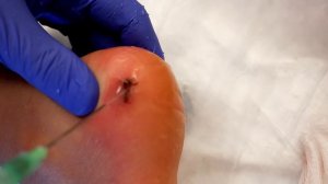 INFECTED GASH ON HER HEEL...(We Had to Deep Clean) | Dr. Paul