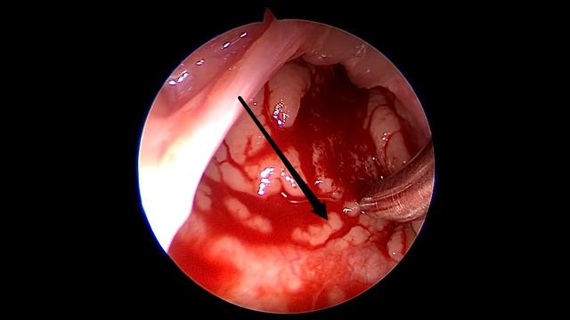 ЭНДОСКОПИЧЕСКАЯ АДЕНОТОМИЯ смотреть онлайн