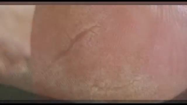 Трескаются пятки смотреть онлайн