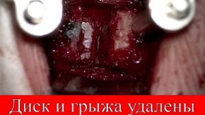 Эндопротез межпозвонкового диска M6