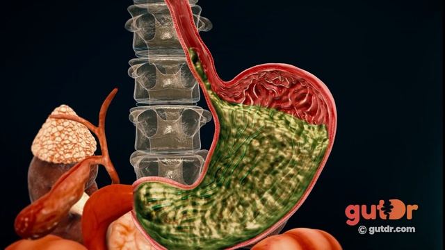 What Is Acid Reflux? | The GutDr Explains (3D Gut Animation) смотреть онлайн