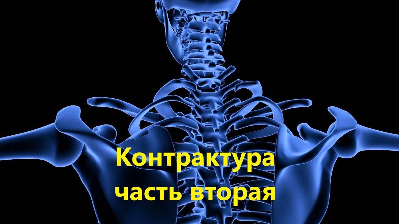 КОНТРАКТУРА. Часть 2. Механизм - осуществляющий ограничение в движении сустава.