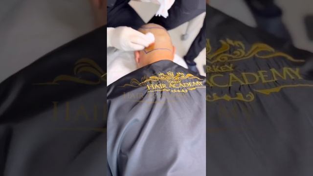 Проходим все этапы пересадки волос вместе с нашими пациентами ? смотреть онлайн