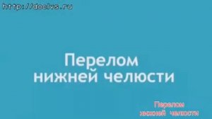 Перелом нижней челюсти