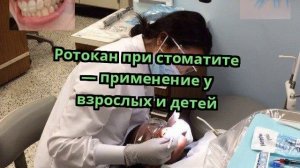 Ротокан при стоматите — применение у взрослых и детей