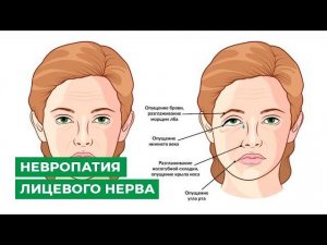 Невропатия лицевого нерва. Паралич Белла. Симптомы, диагностика, лечение. Что эффективнее?