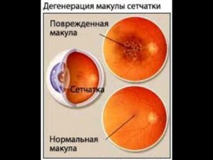 LR возрастная дистрофия сетчатки, как предотвратить и чем восстановить.