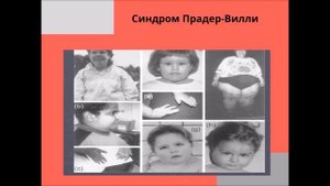 Синдром Шерешевского-Тернера. Синдром Прадер-Вилли