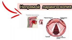 техника не прямая ларингоскопия