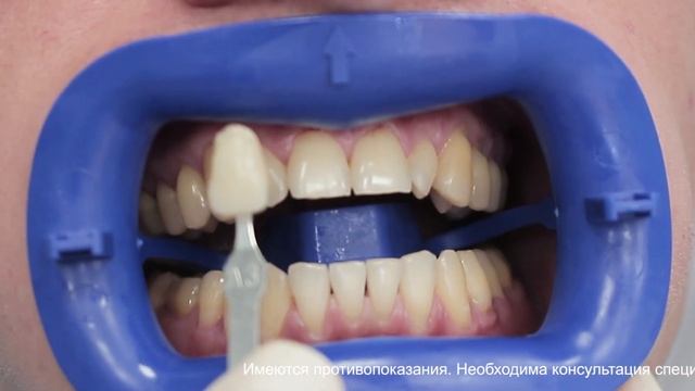 Отбеливание зубов ZOOM4