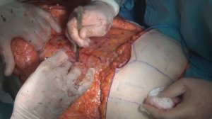 Мастэктомия с реконструкцией TRAM FLAP