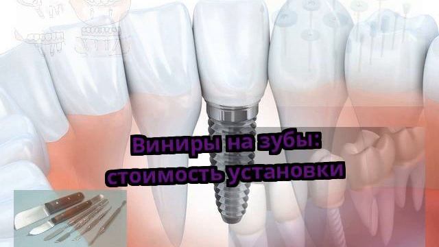 Виниры на зубы: стоимость установки смотреть онлайн