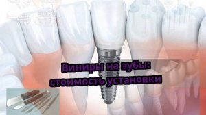 Виниры на зубы: стоимость установки