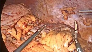 Мегаколон  Долихосигима