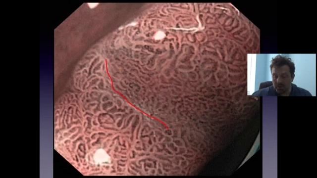 Распознавание минорных признаков паталогии слизистой желудка смотреть онлайн