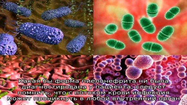 Температура при пиелонефрите смотреть онлайн