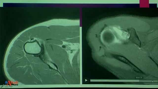 Dr Gaurav Sharma : MRI shoulder anatomy & MRI in shoulder instability at MGM Hospital, Aurangabad смотреть онлайн