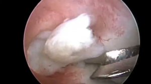 Резекция мениска