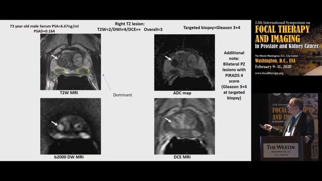 33 Peter Choyke USA PIRADS 3 worthy of targeted biopsy or low yield смотреть онлайн
