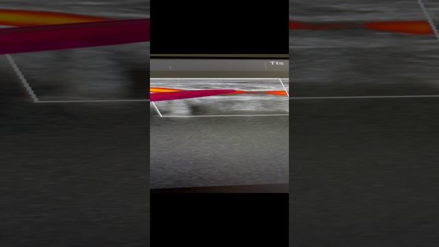 Ангиопатия. Атеросклероз. Медиасклероз. Узи сосудов. Сахарный диабет. Сосудистый хирург. Флеболог смотреть онлайн