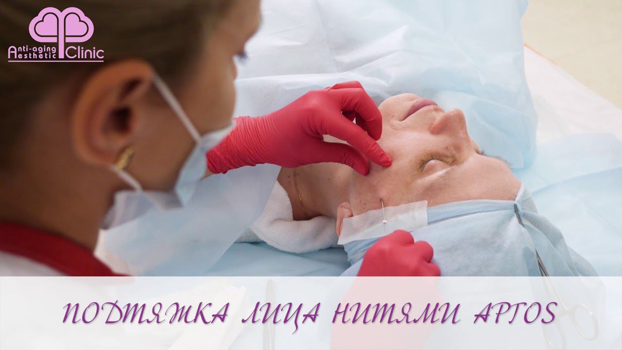 Нитевой лифтинг нитями Aptos Москва. А клиника.