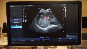 Samsung Medison HS30 обзор ультразвукового сканера