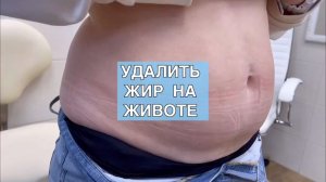 Удаление излишков жировых отложений на животе. Результат сразу!